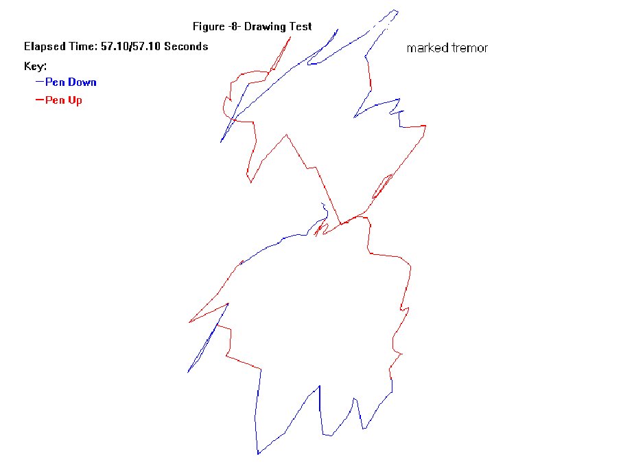  Drawing a figure of eight on a sensorised writing tablet. Tremor affects writing and other fine control of movement.